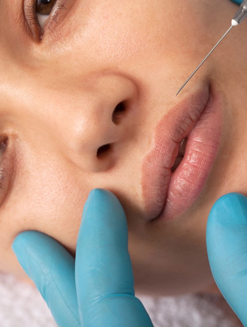 Service Detail Page-What's Included-Injectables-Lip Filler