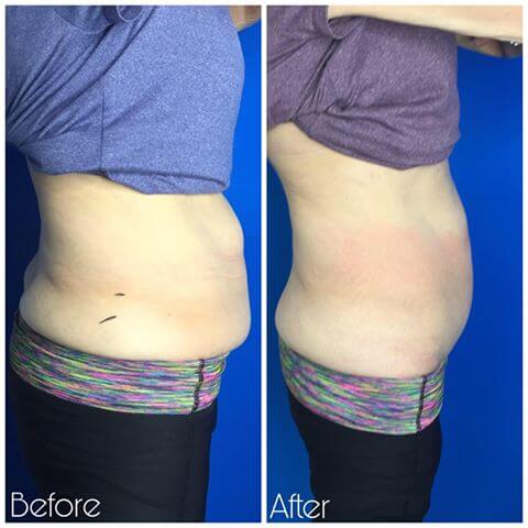 CoolSlim Stomach Wrap. Stomach Firming Treatment